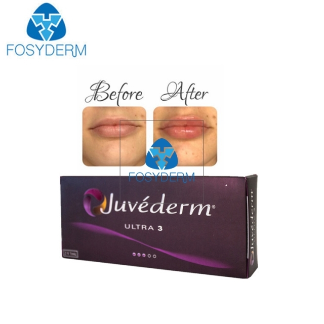 Hyaluronic Acid Dermal Filler Lip Augmentation Juvederm Ultra3 1ml*2pcs