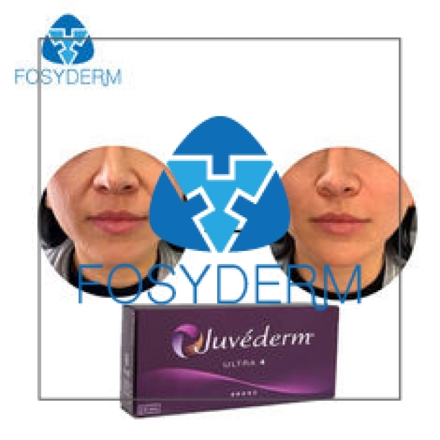 Juvederm Cross Linked Hyaluronic Acid Dermal Filler Allergan Ultra 4