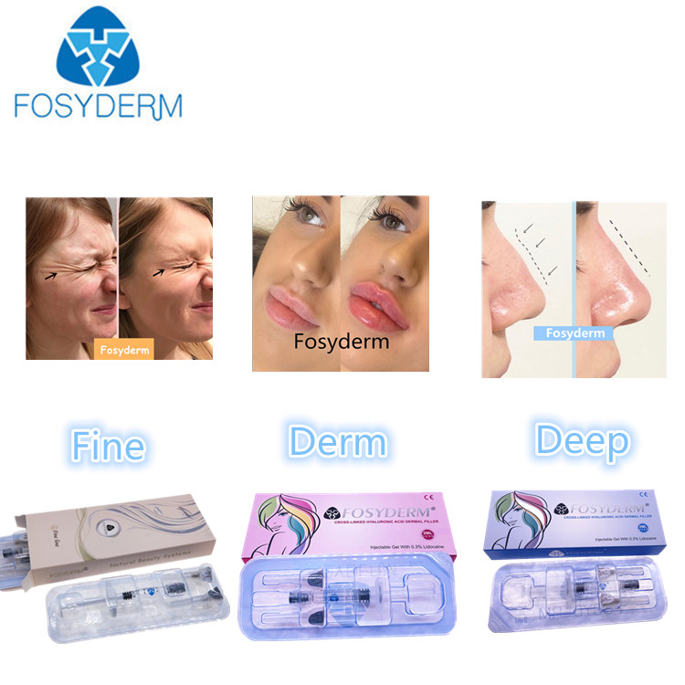 Fosyderm Hyaluronic Acid Dermal Filler 1ml Derm Lip Enhancement Injectable Dermal Fillers