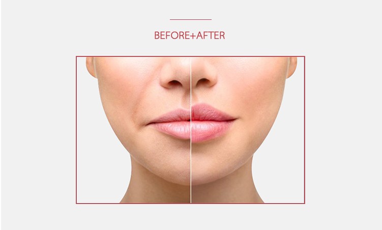 Hyaluronic Acid Dermal Filler Lip Augmentation Juvederm Ultra3 1ml*2pcs