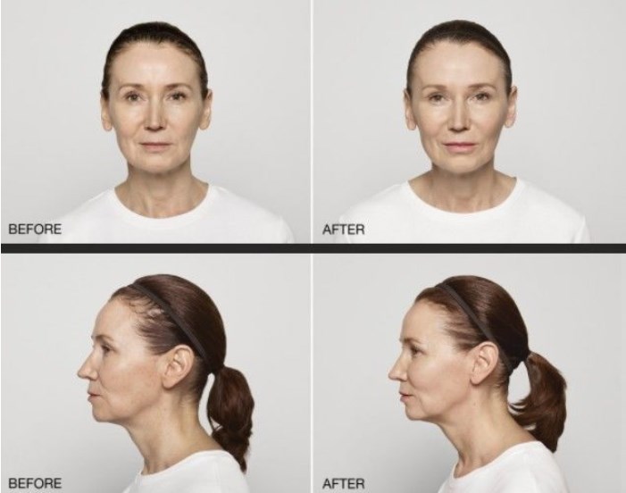 Restylane Lyft With Lidocaine HA Dermal Filler 1ml Gel Injections for Lips Facial contour reshaping