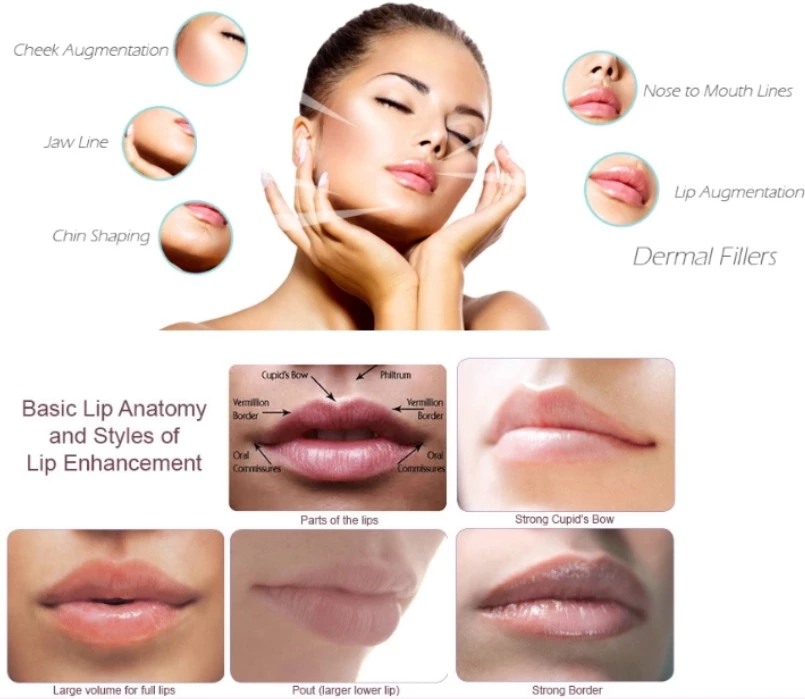 CE Approved Restylane Lyft Hyaluronic Acid 1ml Dermal Filler