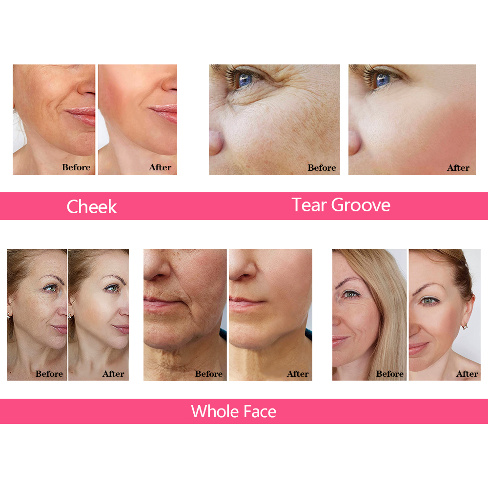 1ml Restylane Lidocaine Hyaluronic Acid Dermal Filler Anti Wrinkles