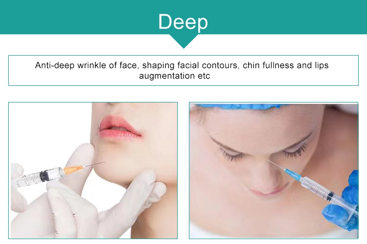 Fosyderm Face Filler 1ml Deep Line HA Dermal Chin Nose Filler