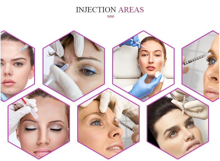 Fosyderm Face Filler 1ml Deep Line HA Dermal Chin Nose Filler