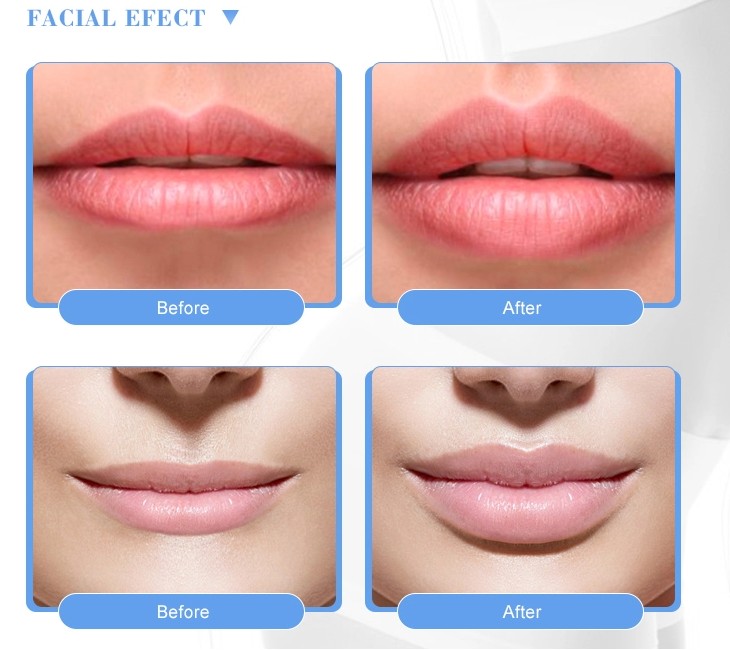 Korea 1.1 ml Revolax Deep Hyaluronic Acid Dermal Filler Lip Enhancement