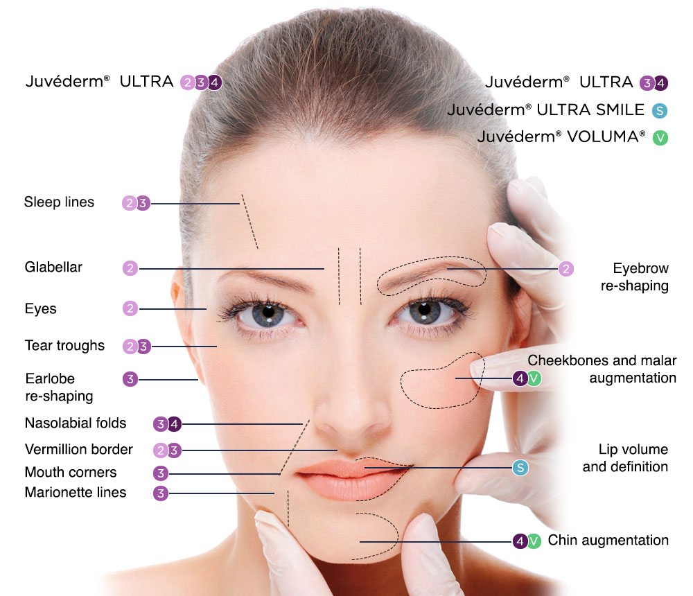 Juvederm Ultral 4 Hyaluronic Acid Dermal Filler Injections with Lidocaine