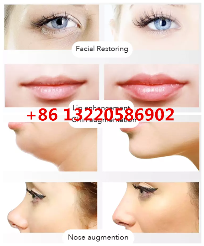 Juvederm Ultral 4 Hyaluronic Acid Dermal Filler Injections with Lidocaine