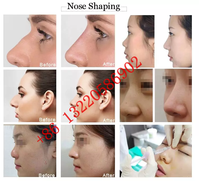 Juvederm Voluma 2 * 1 ml Hyaluronic Acid Dermal Fillers Gel For Nose Up