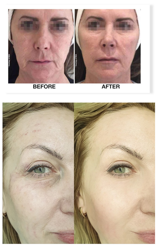 Wrinke Remove Korea Botulinum Toxin 100units Botox  Inject Facial