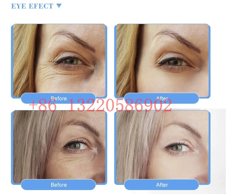 1 . 1 ml Dermal Filler Cross linked Hyaluronic Acid Remove Facial Wrinkles