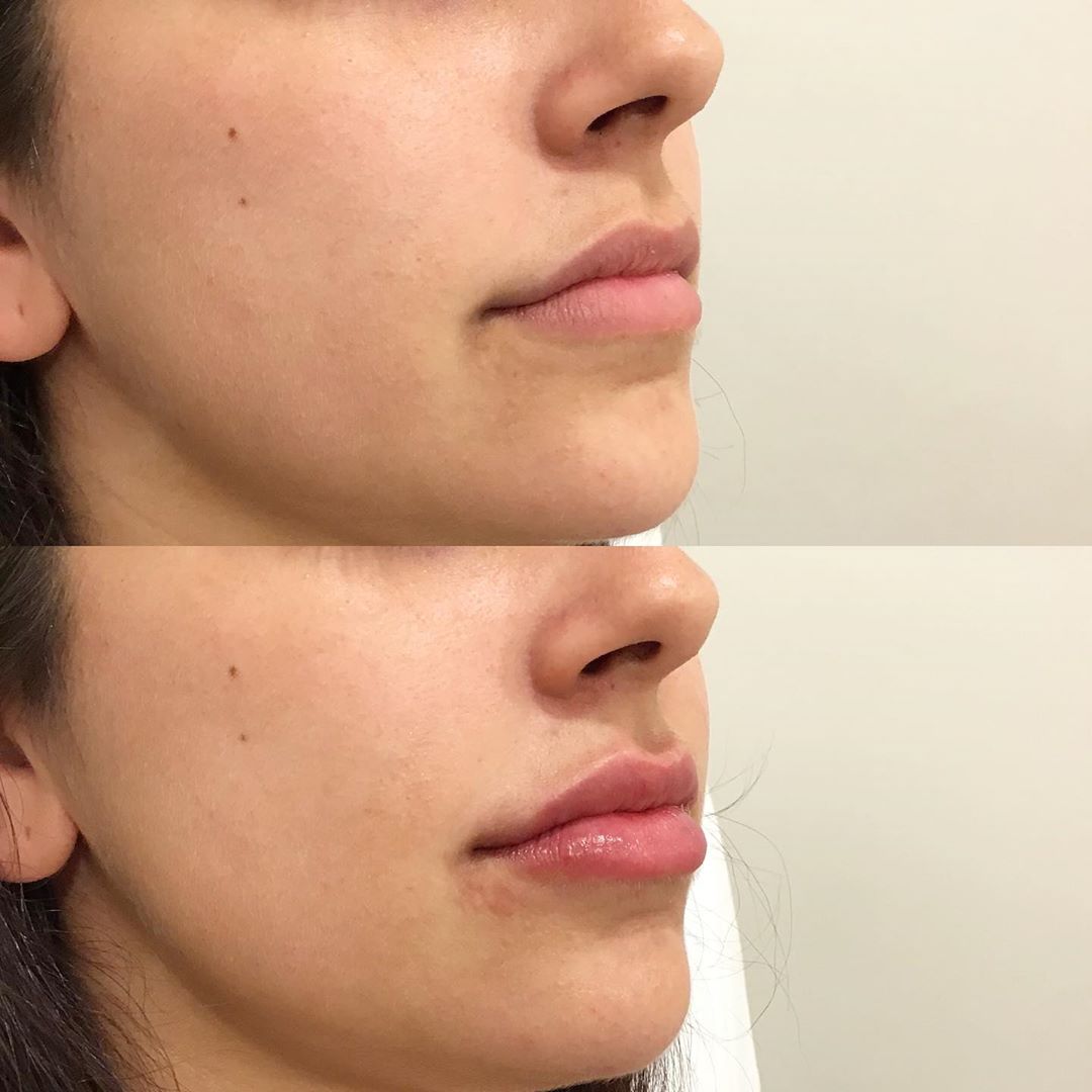 Fosyderm 1ml Derm Line Dermal Filler For Lips Enhancement