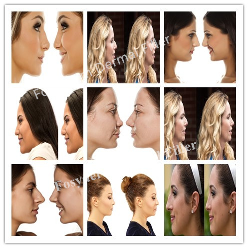 Juvederm Voluma Cross Linked Hyaluronic Acid Dermal Filler For Nose And China With 2 * 1 Ml