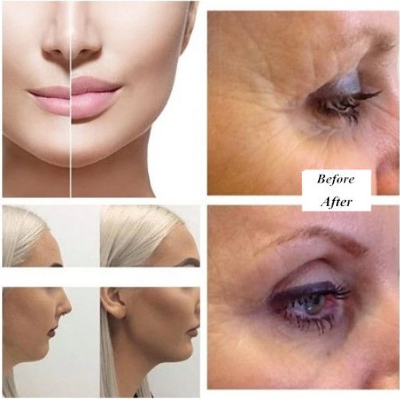 Fosyderm 5ml Deep Dermal Filler for Shaping Facial Contour