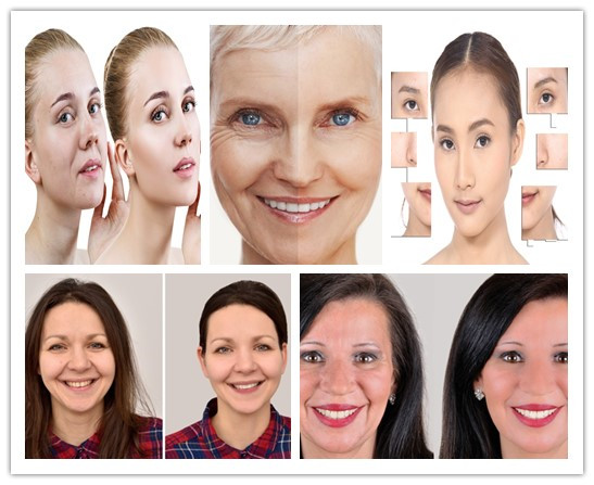 Fine Wrinkles Removing By Injecting 1.1 Ml Korea Revolax Fine Dermal Filler