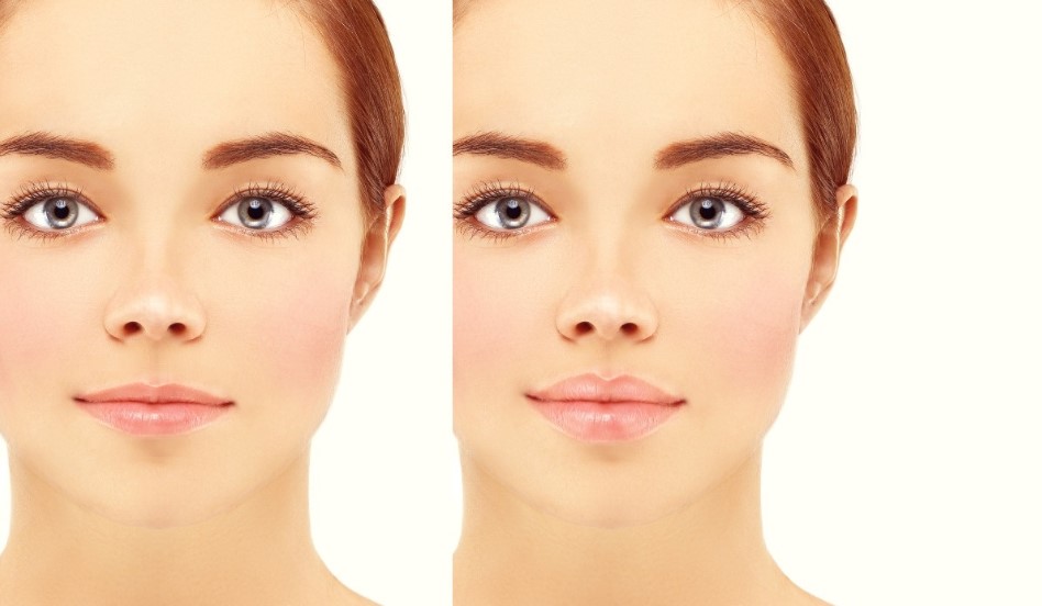 Korea Revolax 1.1 Ml Deep Injectable Hyaluronic Acid Dermal Filler For Lips Enhancement