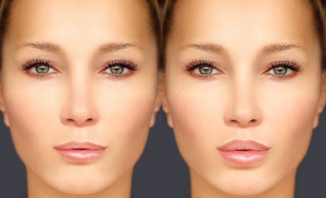 Korea Revolax 1.1 Ml Deep Injectable Hyaluronic Acid Dermal Filler For Lips Enhancement