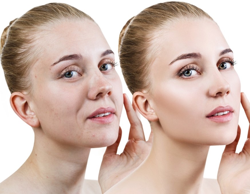 Korea Revolax Injectable Hyaluronic Acid Dermal Filler 1.1 Ml Sub - Q To Removing Deep Wrinkles