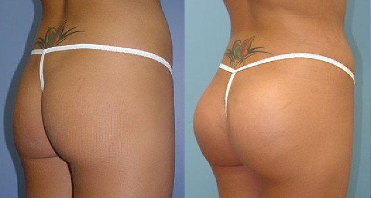 Fosyderm 20 Ml Subskin Hyaluronic Acid Dermal Filler For Breast And Buttocks Enlargement