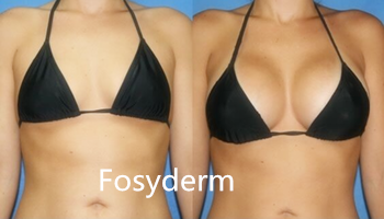 Fosyderm 20 Ml Subskin Hyaluronic Acid Dermal Filler For Breast And Buttocks Enlargement
