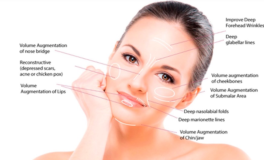 Juvederm Ultra3 Injectable Dermal Filler HA Gel Injection