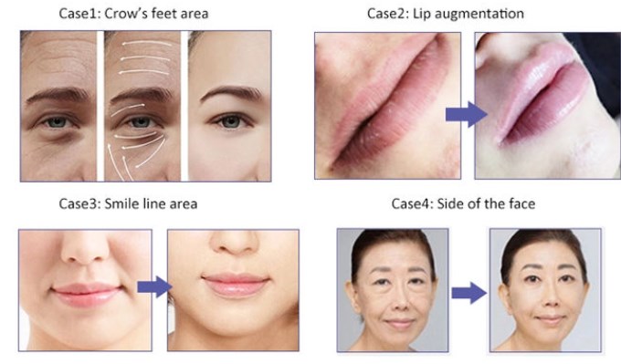 2ml Fine Lines Filler for Anti Wrinkles HA Gel Dermal Filler CE certificate