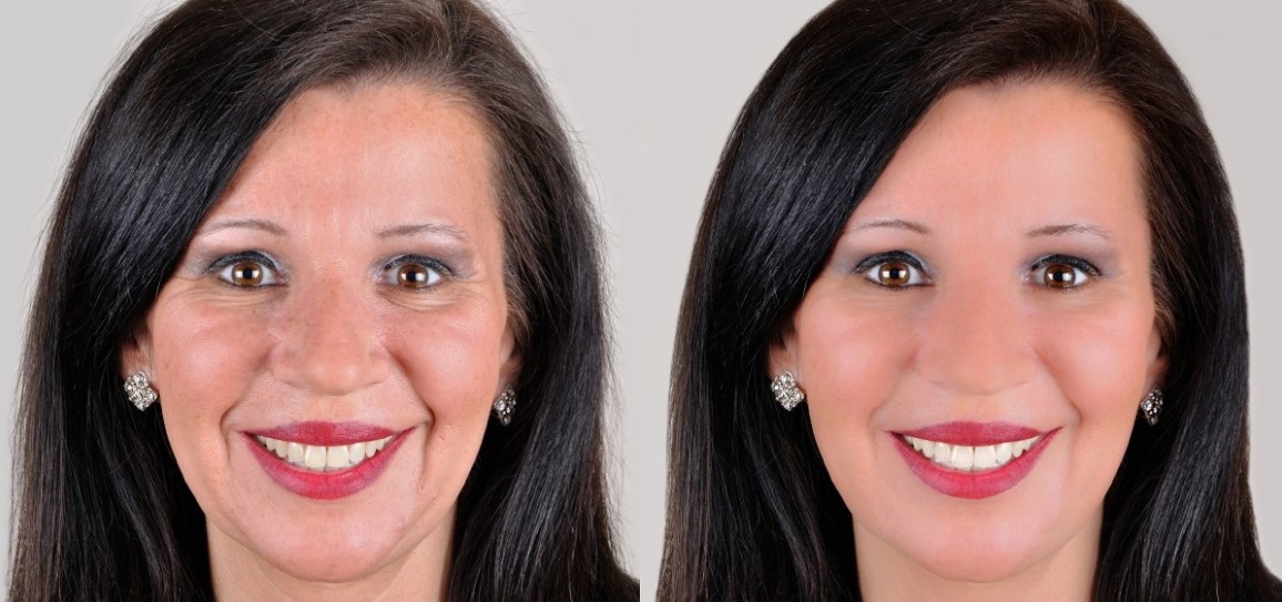 Mesotherapy Solution Improve The Luster Of The Skin By Injecting 5 Ml 3 AA +