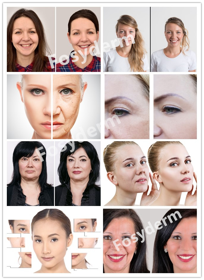 Mesotherapy Solution 5 Ml 18 AA+ Hyaluronic Acid Make The Skin Look Younger