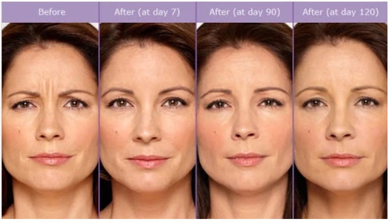 Korea Hyamely Botox Botuliumme toxin type A injection 100units