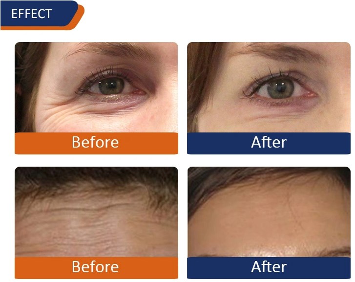 Anti Wrinkles Injection Botox Toxin 100iu Botulinum Toxin