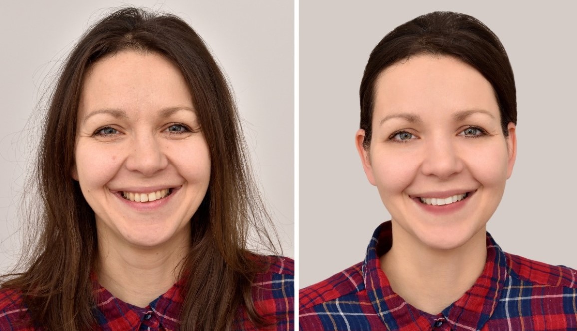 Restylane 1 Ml Lyft HA Dermal Filler To Correction Of Moderate To Severe Facial Wrinkles And Folds