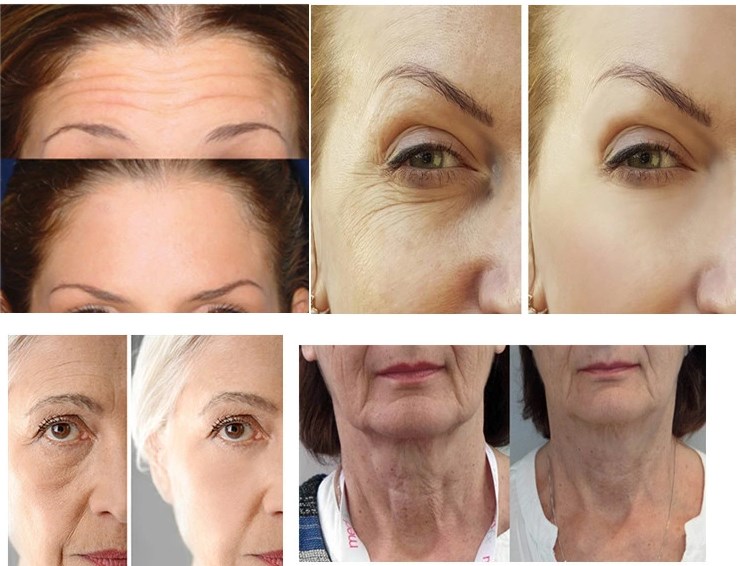 Botox 100IU Botulinum Toxin Anti Wrinkles Powder Filler High Quality