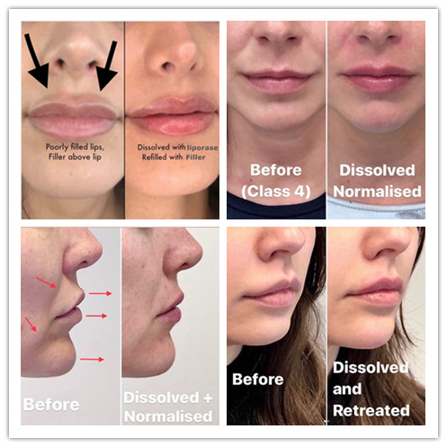 Korea Liporase 10 Vials Hyaluronidase To Break Down The Hyaluronic Acid Dermal Filler