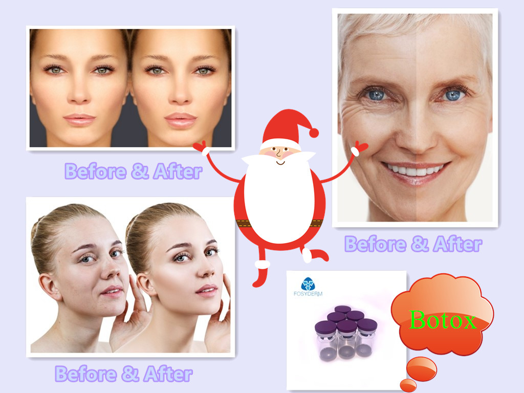Reducing Wrinkles By Injecting Type A 100 IU Botox
