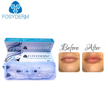 Fosyderm Hyaluronic Acid Dermal Filler 1ml Derm Lip Enhancement Injectable Dermal Fillers