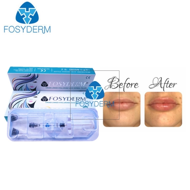 Fosyderm Hyaluronic Acid Dermal Filler 1ml Derm Lip Enhancement Injectable Dermal Fillers