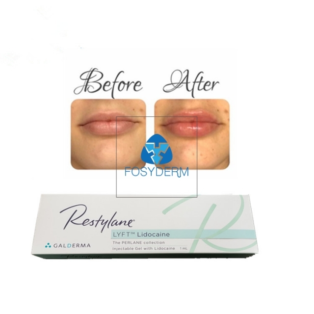 CE Approved Restylane Lyft Hyaluronic Acid 1ml Dermal Filler