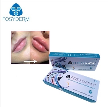 1ml Hyaluronic Acid Dermal Filler Injections to Increase Lips Size