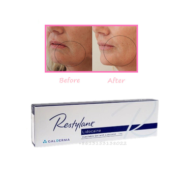 Restylane Filler Restylane with Lidocaine 1ml Anti Aging Hyaluronic Acid Dermal Filler