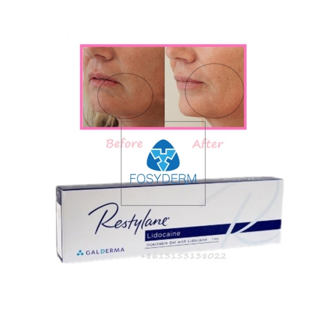 Restylane Filler Restylane with Lidocaine 1ml Anti Aging Hyaluronic Acid Dermal Filler