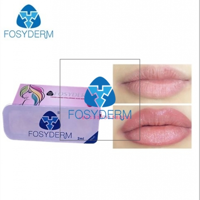 CE Injectable Ha Hyaluroinc Acid Lip Fullness Dermal Filler 2ml