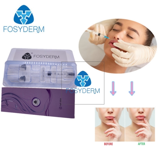 Lips Filler By Injecting Fosyderm 5 ML Derm Hyaluronic Acid